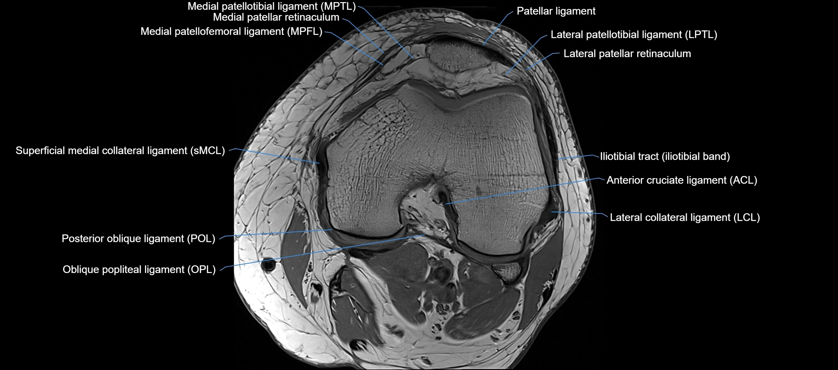 MRI Knee axial  ligaments cross sectional anatomy 3T  radiology  image-img-03001-00021.webp
